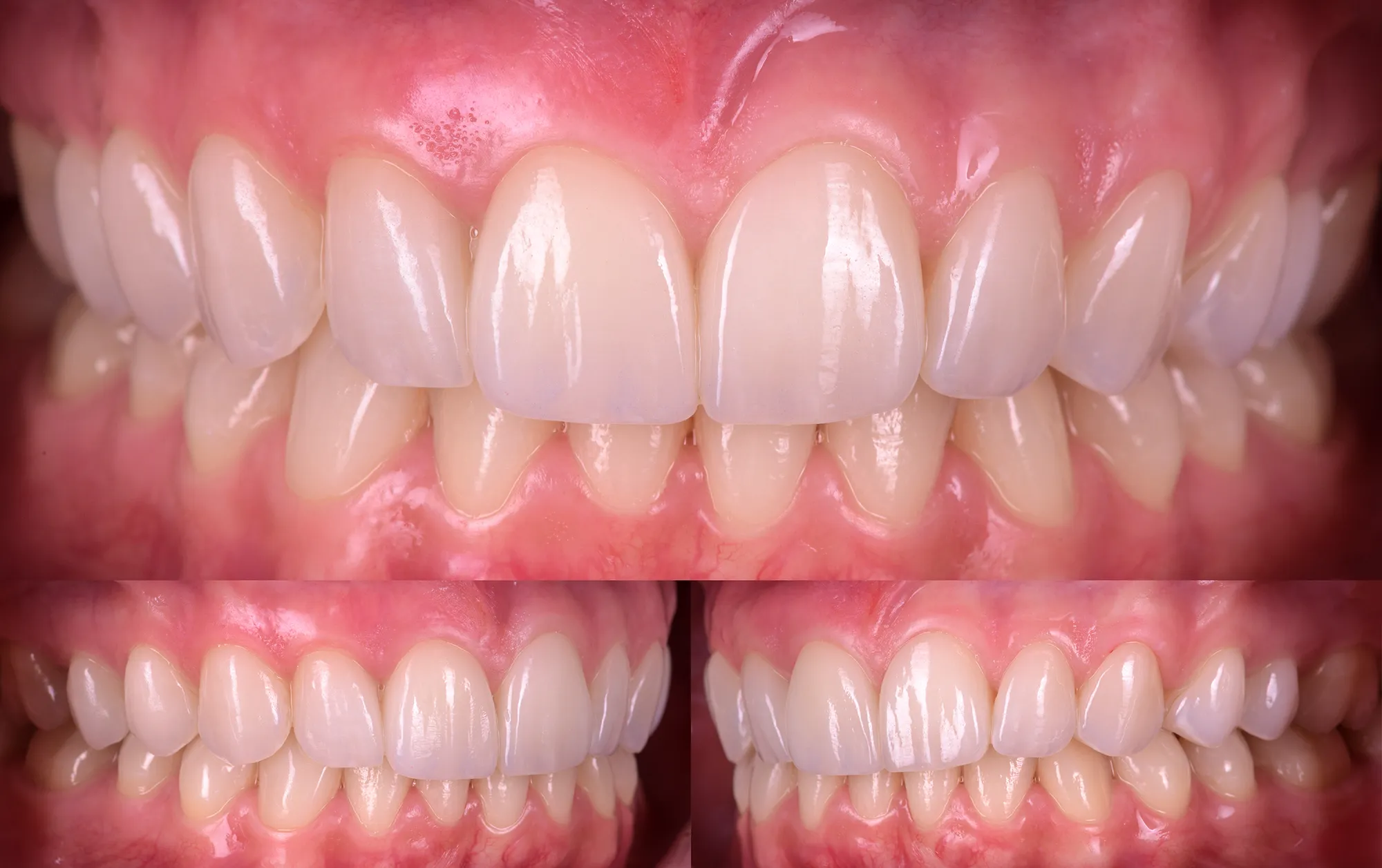 A patient's bite seen from the front and from both sides