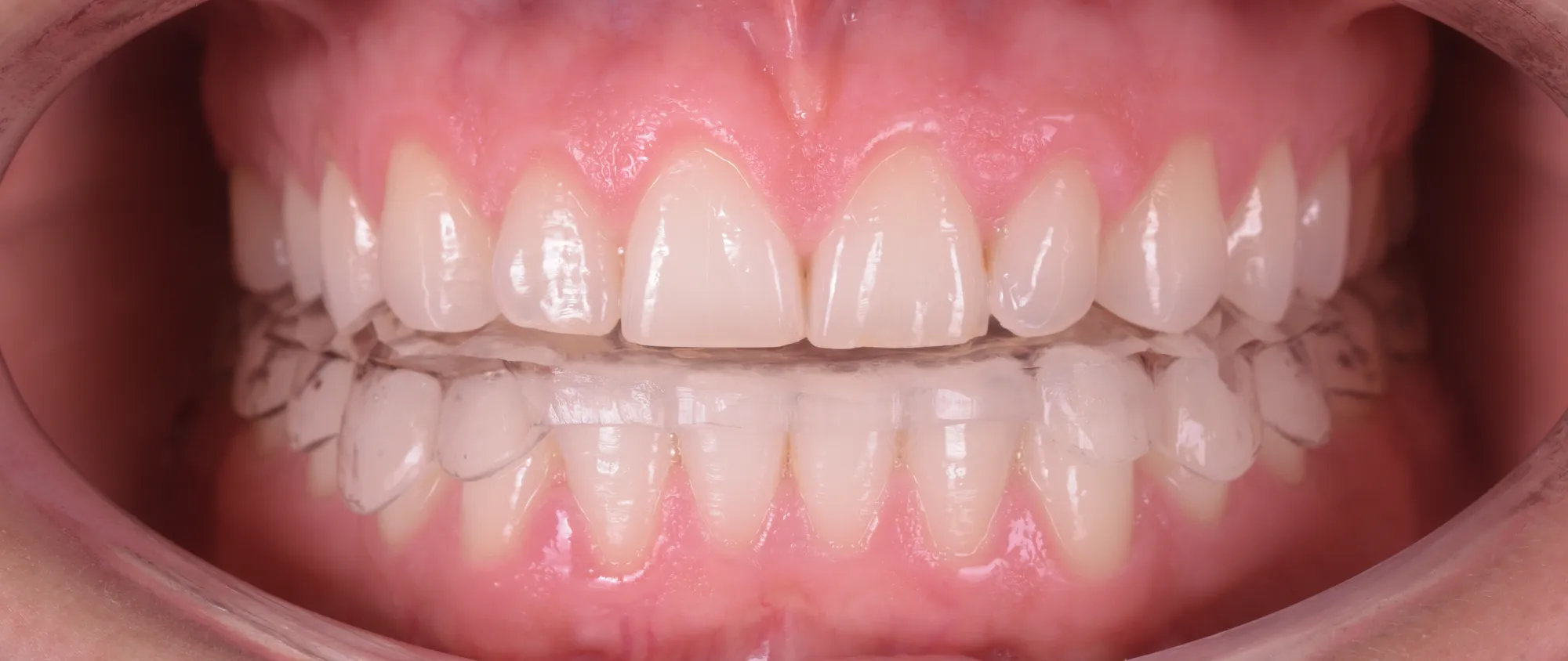 Clear diagnostic splint worn over the teeth