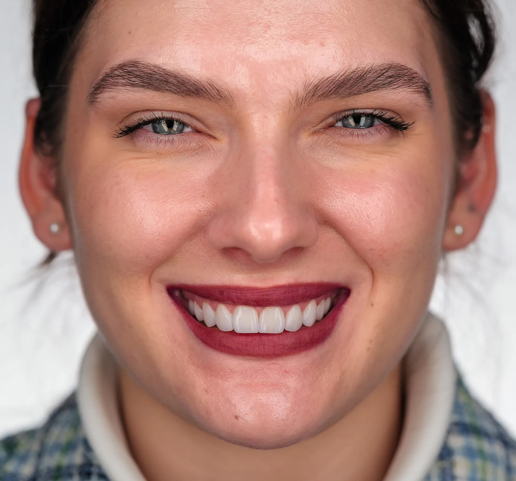 Old composites replaced with ceramic veneers