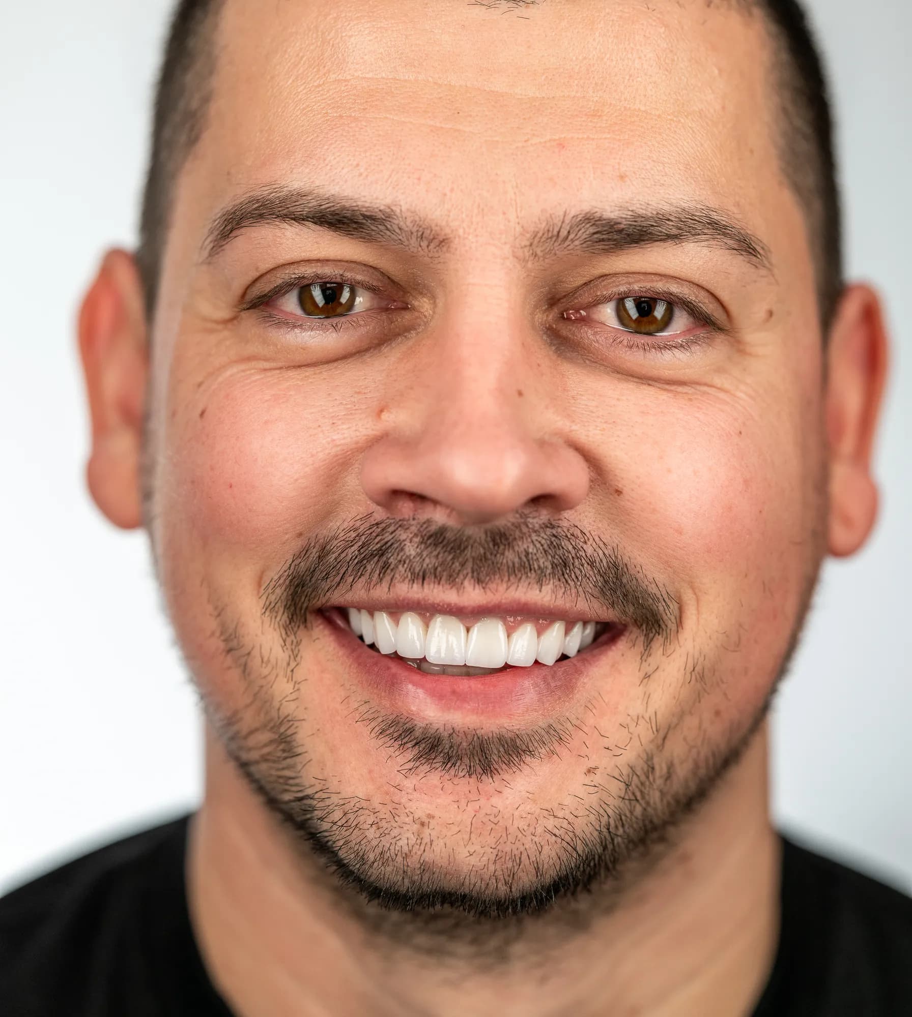 Orthodontics, gum contouring and new veneers