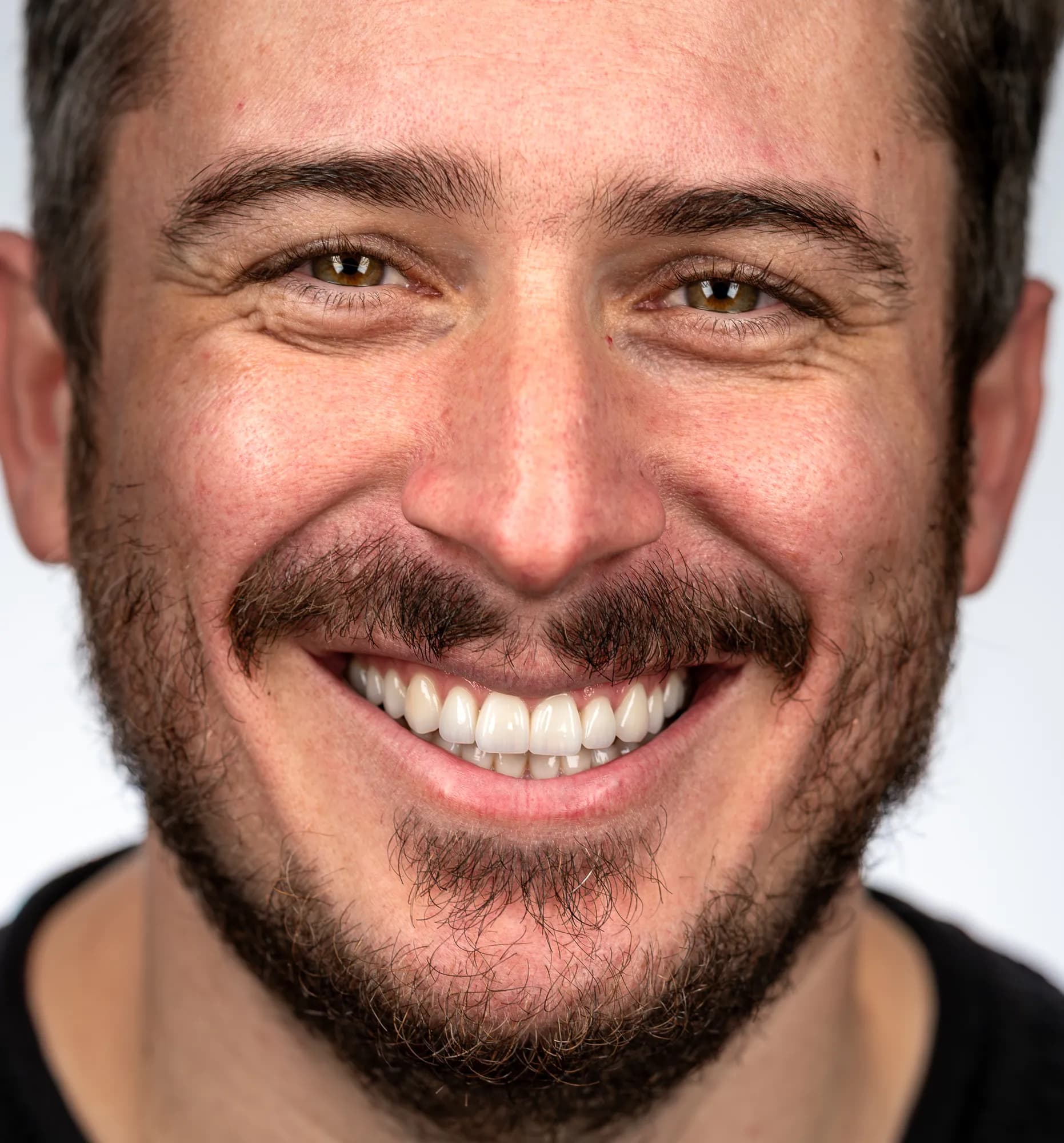 Orthodontic intrusion, implants and veneers
