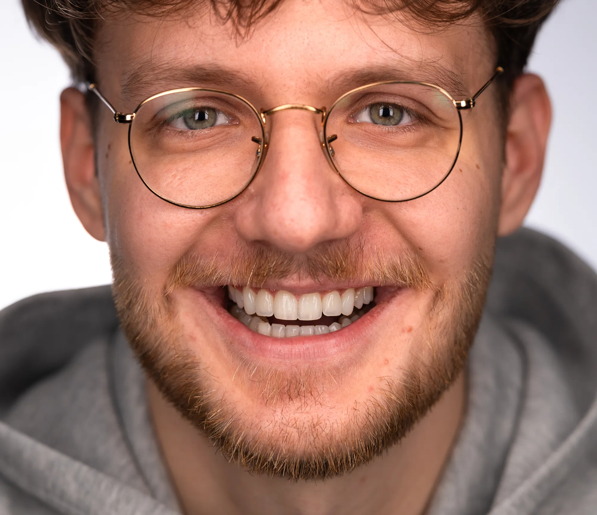 Orthodontics, then no-prep additive veneers