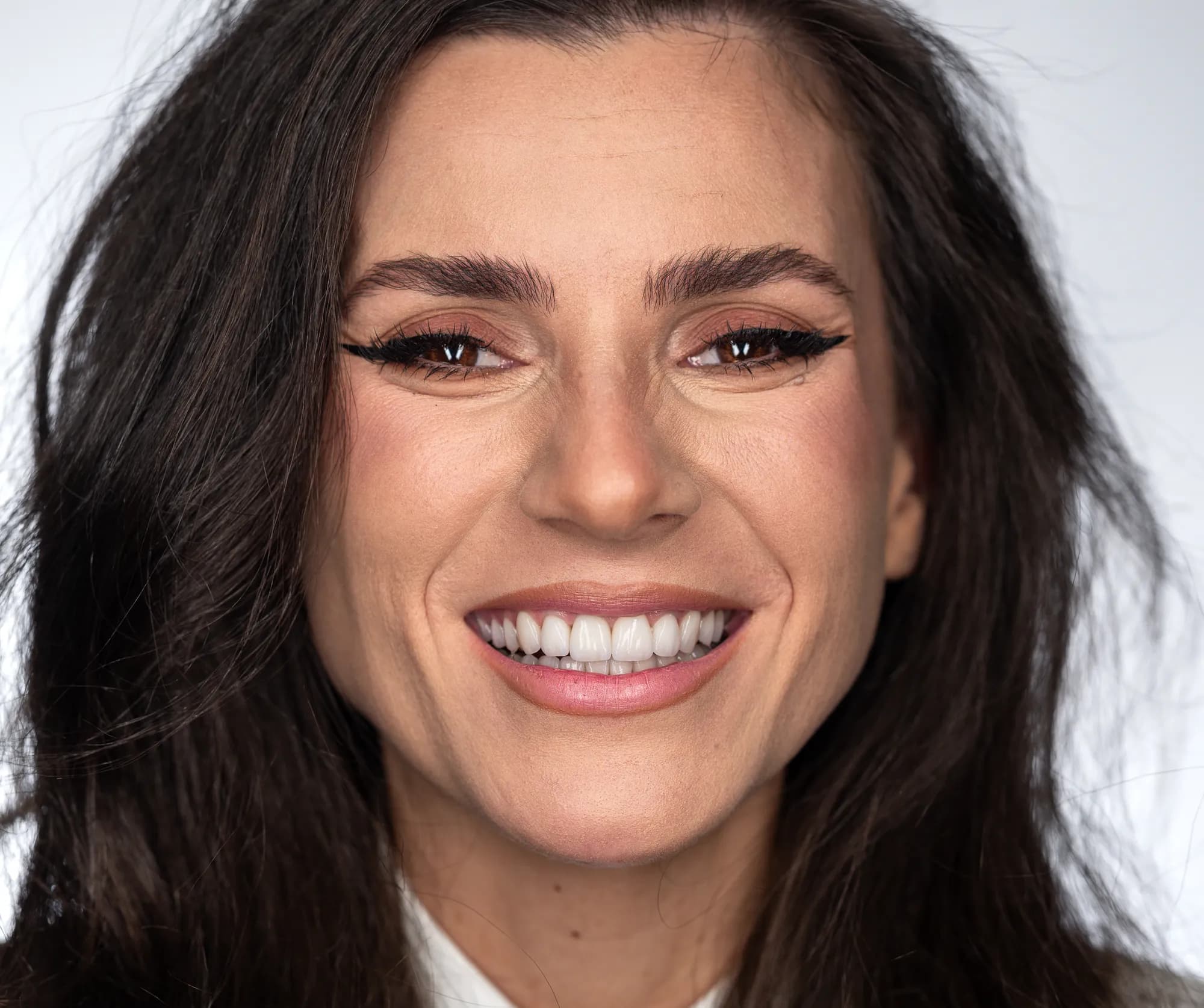 Aligners and jaw surgery, finished with veneers