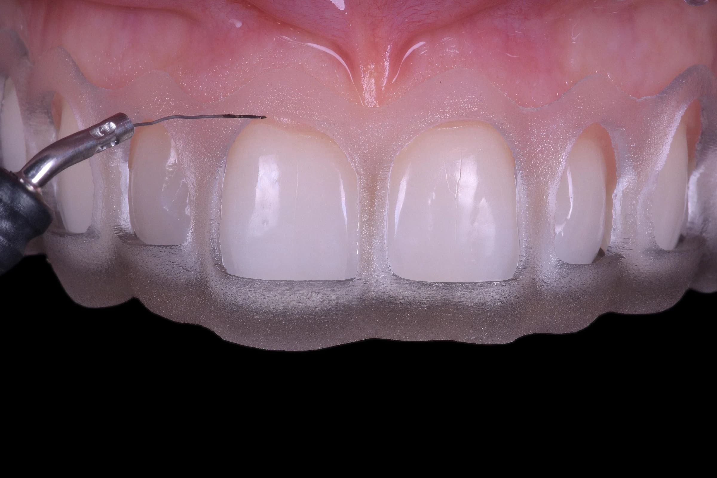 The gum line reshaped through a guide made from the design