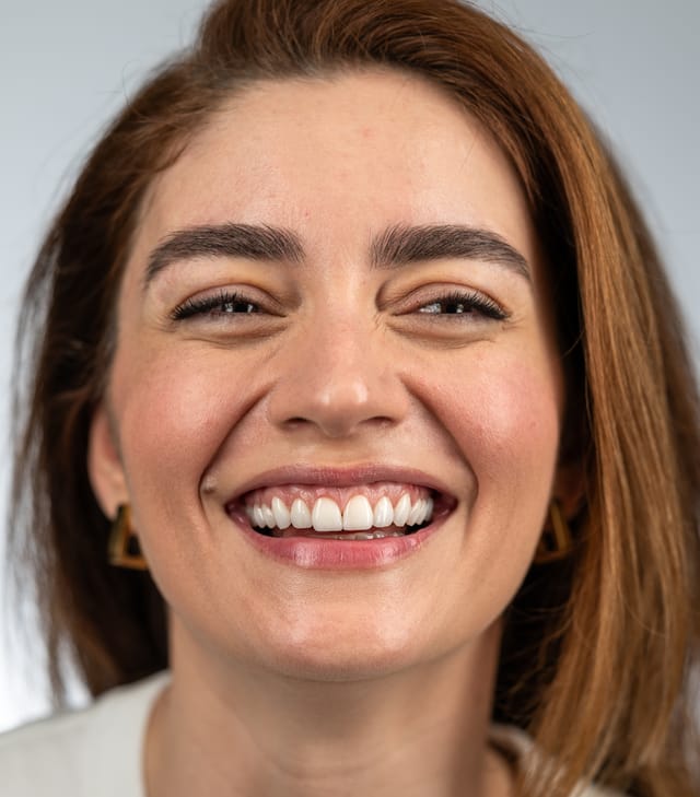 Post-treatment frontal portrait showing balanced gingival levels and natural tooth proportions.