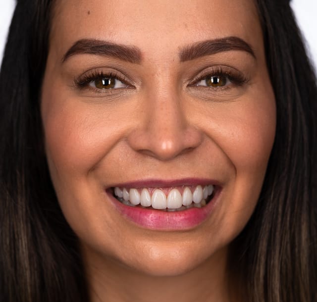 Macro view of monolithic veneers after crown lengthening, showing refined emergence profile and surface detail.