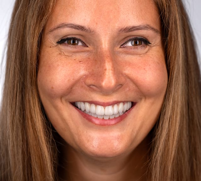 A fixed, screw-retained bridge supported by implants — designed to follow the patient’s natural tooth emergence and preserve soft tissue contours.