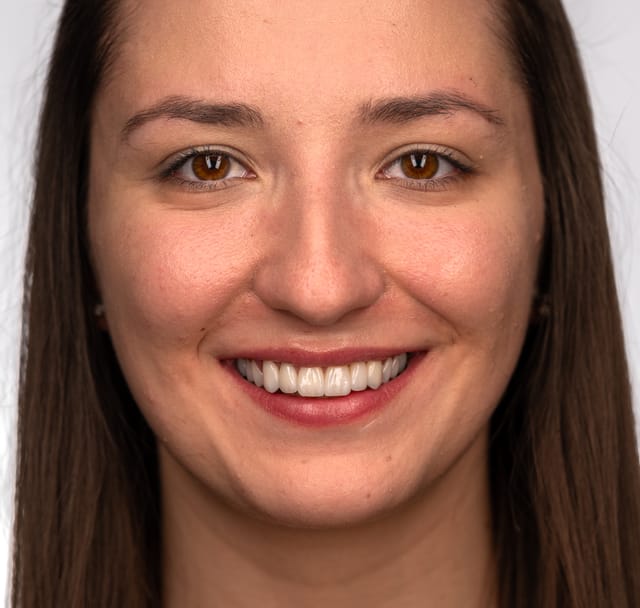 Cervical emergence and papilla shape rebuilt digitally. No repetition — each tooth follows its own logic.