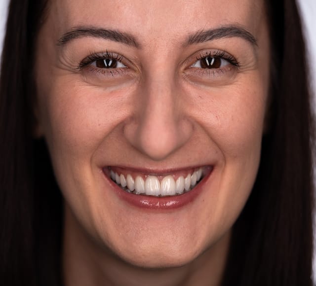 Full-face portrait showing skeletal harmony and smile symmetry after ortho and implants.