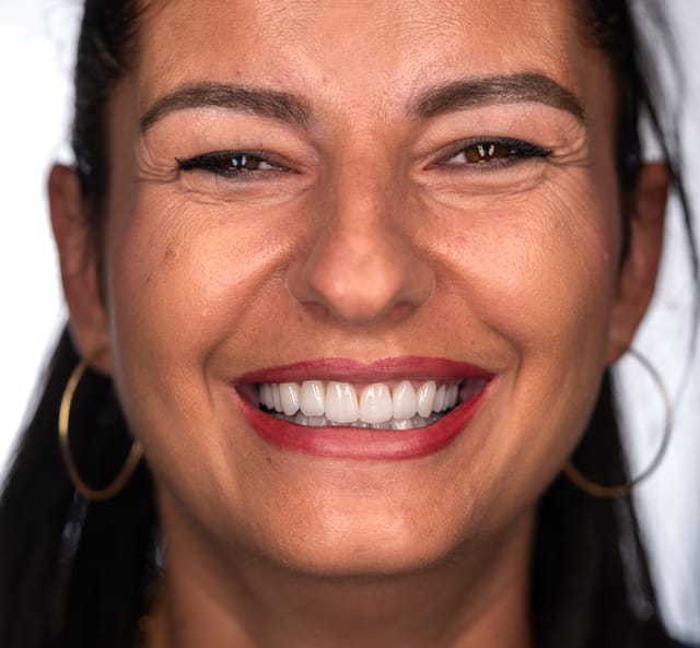 Proportions and perioral support restored — without altering expression.